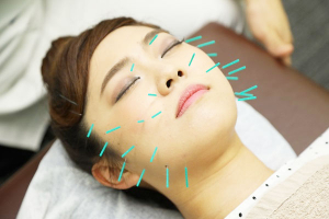 かみなかひかり鍼灸院接骨院の美容鍼施術の画像