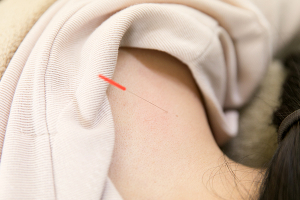 こうたろう鍼灸整骨院の鍼灸施術の画像