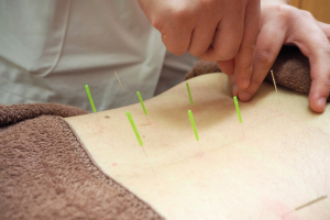 大江戸鍼灸整骨院の鍼灸の施術画像