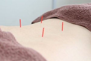 いるか堂鍼灸整骨院の鍼灸の施術画像