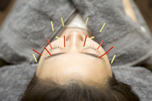 城野とも鍼灸整骨院の鍼灸施術の画像