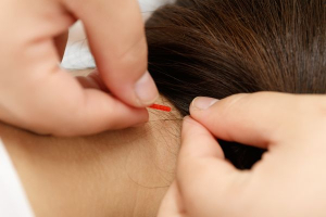 アクア整骨院の肩こりの施術画像