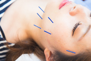 鈴木接骨院併設ドルフィンはりきゅう院の美容鍼の施術画像