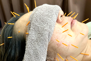 さくら鍼灸整骨院　上野院の美容鍼施術の施術風景画像です。