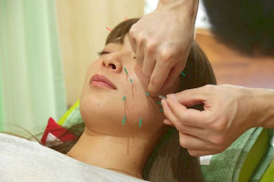 いろは鍼灸整骨院の美容鍼施術の画像