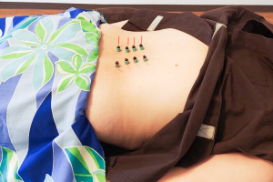 lima ho ola 鍼灸整骨院の鍼灸施術の画像