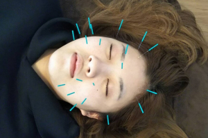 lima ho ola 鍼灸整骨院の美容鍼の施術画像