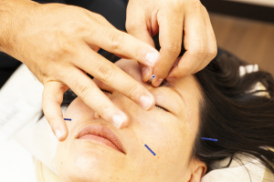 ワイズ整骨院／ワイズ鍼灸マッサージ院の鍼灸の施術画像