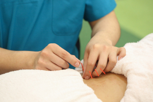 リセット整骨院　ひょうたんやま北院の鍼灸施術の画像