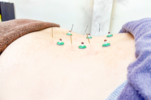 甲斐整骨院　薬院【鍼灸】の腰痛りの施術画像