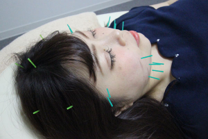ＭＵＧＥＮ鍼灸整骨院の美容鍼の施術画像