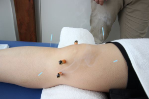 いいだ鍼灸院 / IIDA LABの鍼灸施術の画像