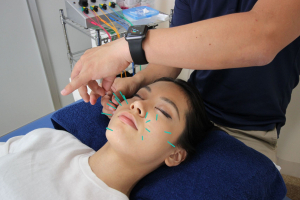 いいだ鍼灸院 / IIDA LABの美容鍼施術の画像