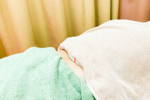 やすらぎ新吉田接骨院・鍼灸院の鍼灸の施術画像