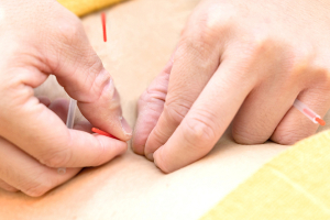 ＶＩＶＡ鍼灸整骨院　甲南院の鍼灸施術の施術風景画像です。