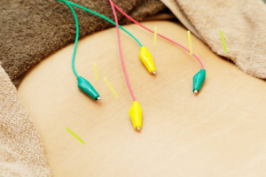 蘇摩鍼灸治療院竹内弘宜の鍼灸施術の画像