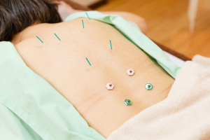 明神前鍼灸治療室の鍼灸施術の画像