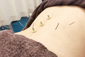 たきかわの整骨院の鍼灸施術の施術風景画像です。