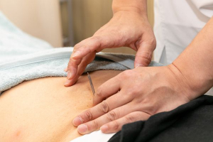 カムイ鍼灸整骨院の鍼灸施術の施術風景画像です。