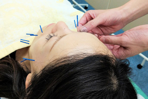 エース治療院の鍼灸施術の施術風景画像です。
