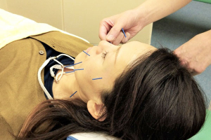 ハッピーライフ治療院【鍼灸】の美容鍼の施術画像