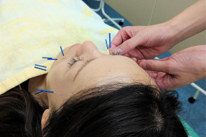 銀座鍼灸整骨院の美容鍼の施術画像