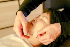 鍼灸兪楽治療院横浜店の美容鍼施術の画像