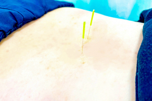 整骨院葵堂　清水院　鍼灸併設院の鍼灸施術の画像