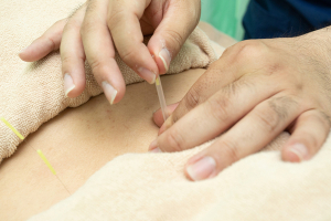 ほねごり接骨院はりきゅう院　海老名院の鍼灸施術の施術風景画像です。の代表的な写真