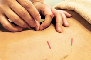 鍼灸マッサージ院　Ｒｅｌｉｆｅの鍼灸施術の画像