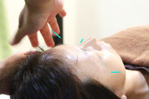 はり灸北千住治療院ウェル・バランスの美容鍼施術の画像