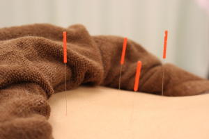 木賀鍼灸整骨院の鍼灸施術の画像