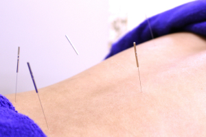 飯田橋駅前鍼灸整骨院の鍼灸施術の施術風景画像です。