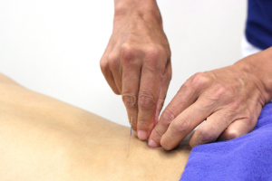 かんだ駅前鍼灸整骨院の鍼灸施術の施術風景画像です。