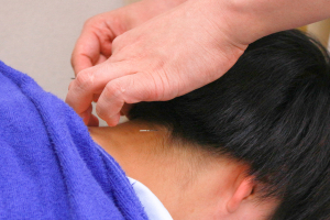 Ｆ．Ｃ．Ｃ．築地鍼灸整骨院の鍼灸施術の施術風景画像です。