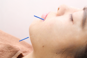 太陽接骨院の美容鍼の施術風景画像です。