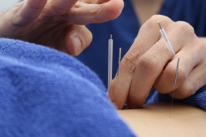 クネア鍼灸整骨院　新浦安院の鍼灸施術の施術風景画像です。