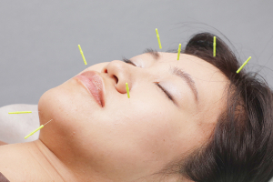 ハリライフ大井町鍼灸整骨院の鍼灸の施術風景画像