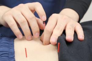 Ｉｃｈｉｇａｙａの鍼灸整骨院の鍼灸施術の施術風景画像です。