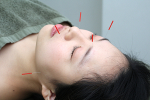 リラクゼーション・はり灸 ＳＴＯＢＥの美容鍼の施術風景画像です。