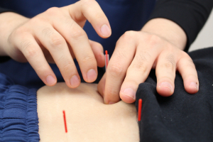 読売ランド前駅のはり灸整骨院の鍼灸の施術画像