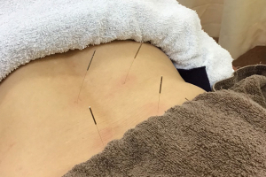 さくら鍼灸整骨院 金沢八景院の鍼灸施術の施術風景画像です。