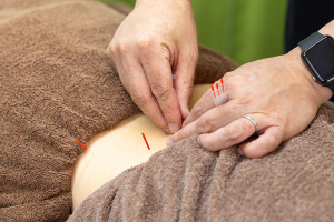 発寒南あおば鍼灸整骨院の鍼灸の施術画像