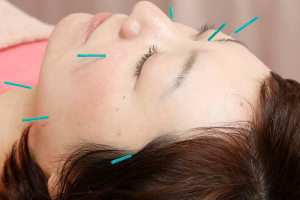 ベストハンズ　三軒茶屋の鍼灸の施術画像