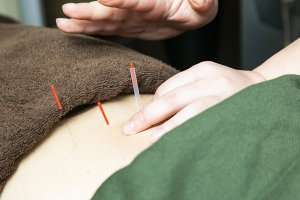 ＶＩＶＡ鍼灸整骨院　六甲道院の鍼灸の施術画像