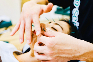 柔道整復院　ｊｕｄｏ－ｓｅｉｆｕｋｕｉｎ　ひばりヶ丘の美容鍼施術の施術風景画像です。