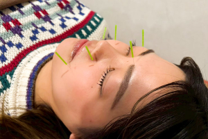 まつば鍼灸整骨院の美容鍼の施術風景画像