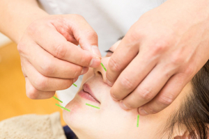 平野　たかま鍼灸整骨院の鍼灸施術の画像