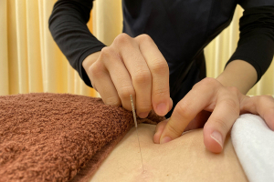 ひだまり鍼灸整骨院の鍼灸施術の施術風景画像です。