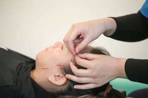 リセット整骨院　やえのさと院の鍼灸施術の画像